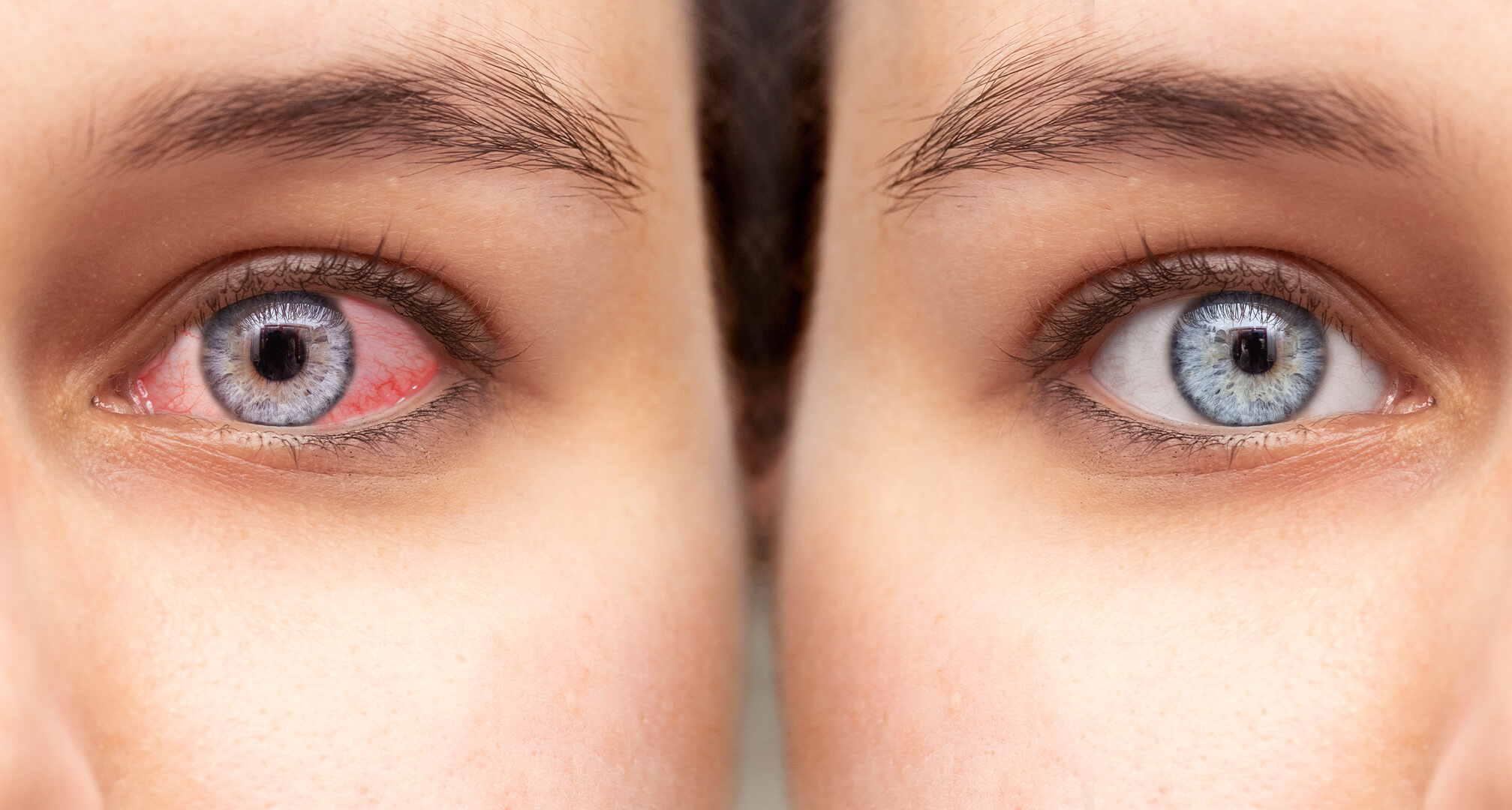close up of two eyes side by side, a red dry eye on the left and a healthy eye on the right