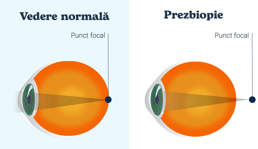 imaginea punctului focal în ochiul normal și în ochiul cu presbiopie