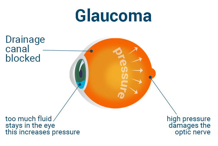 Glaucom de ochi