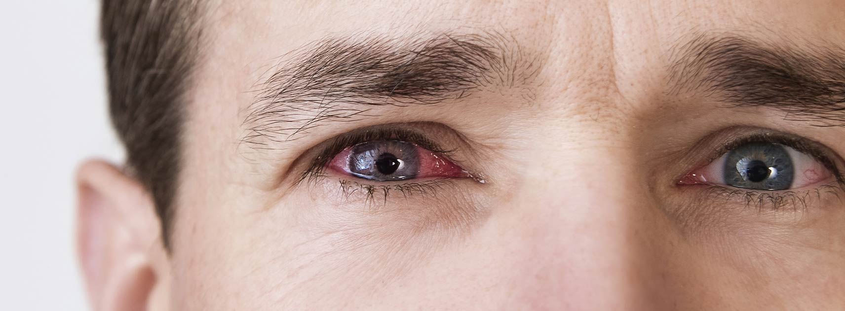Inflamația marginii ochiului