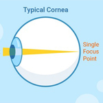 Lumea distorsionată prin ochii oamenilor cu astigmatism: cum văd? - Retină 