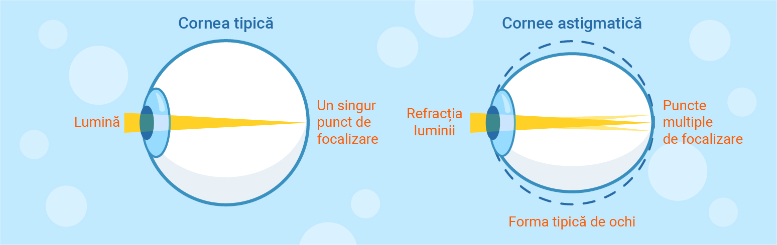 typical and astigmatism cornea